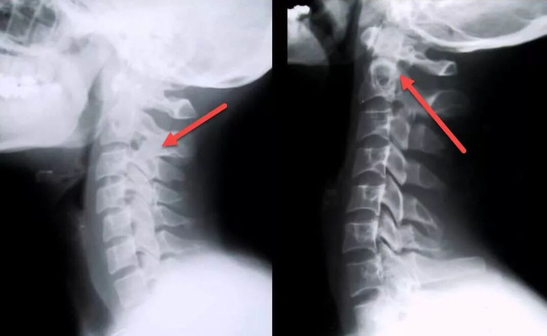 diagnostyka osteochondrozy szyjnej