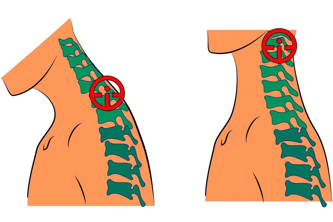 osteochondroza szyjna