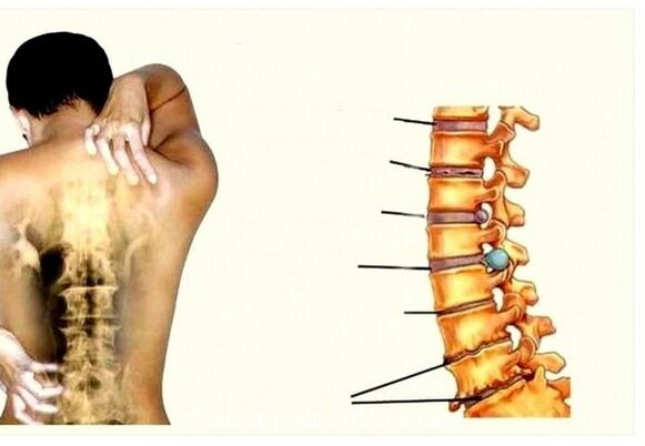 Etapy osteochondrozy szyjnej