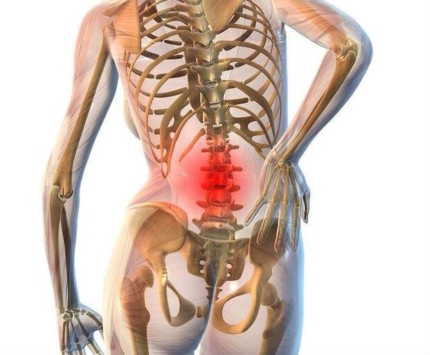Osteochondroza kręgosłupa lędźwiowego